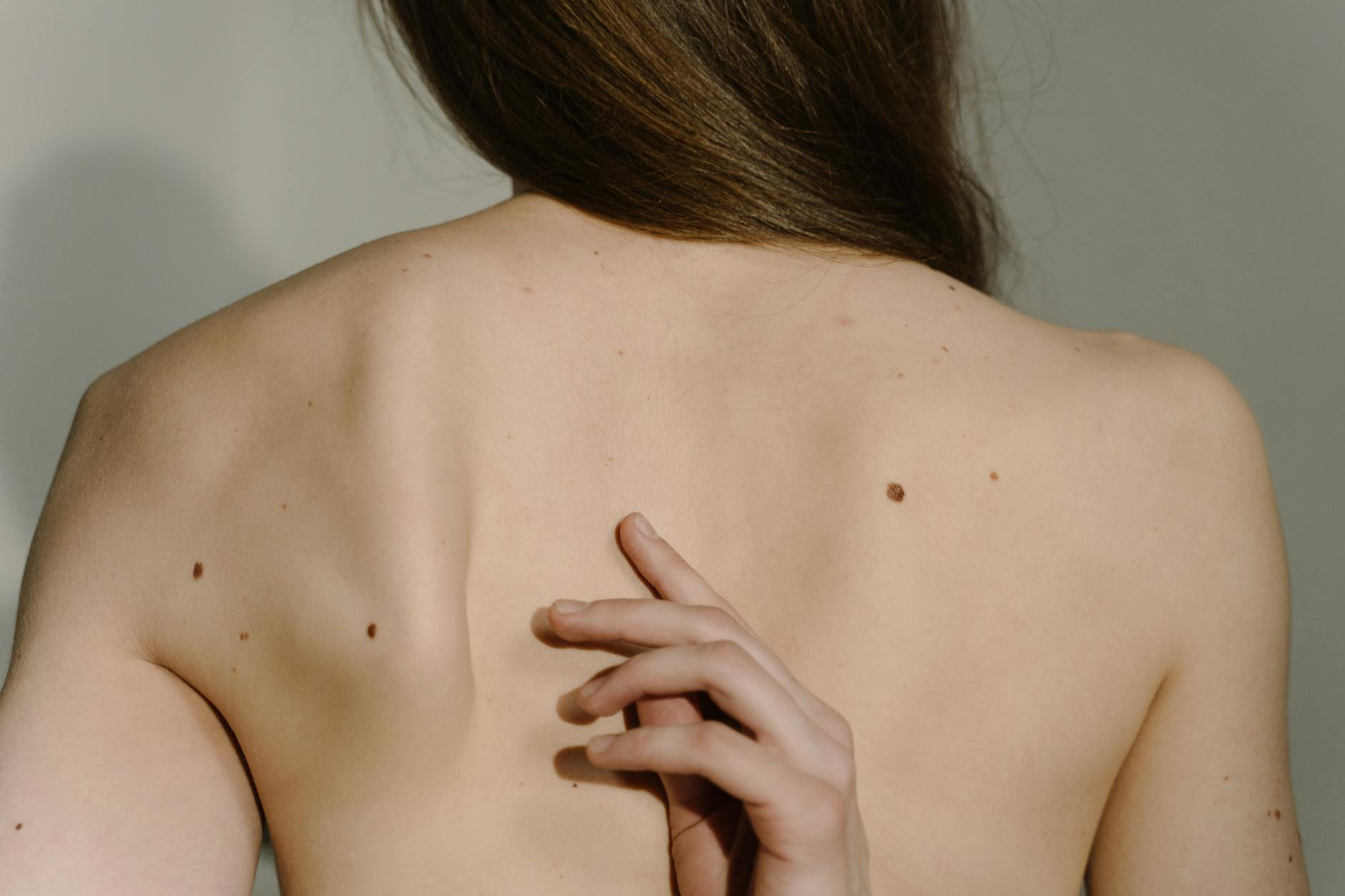 moles on a person s bare back